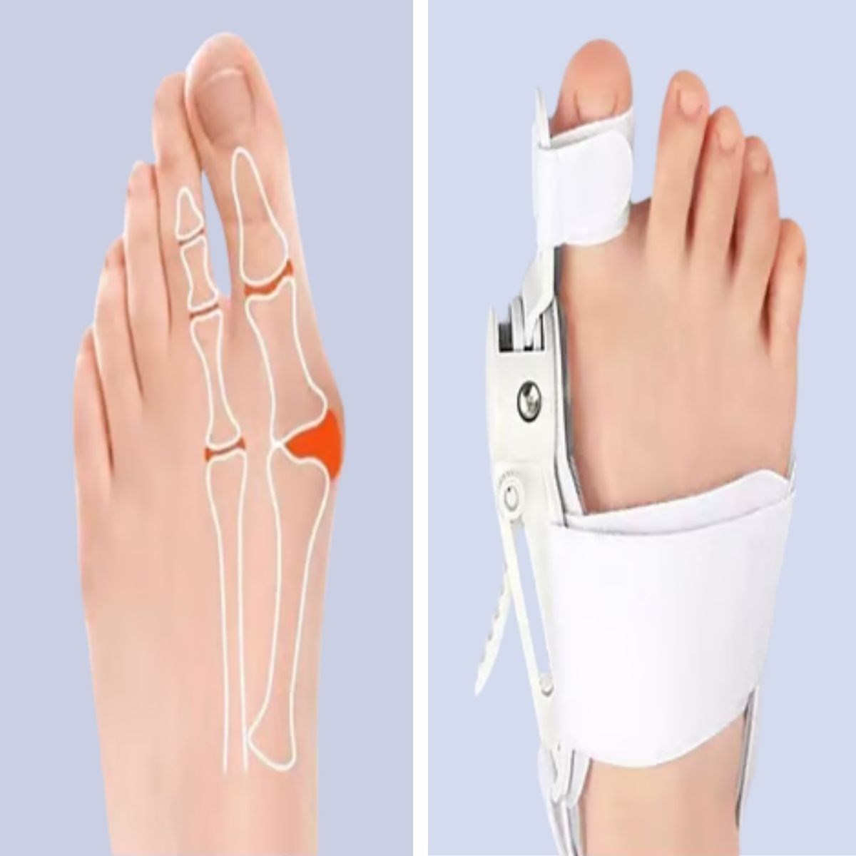 BUFFER Ayarlanabilir Ayak Baş Parmak Kemik Düzeltici – Halluks Valgus (Bunyon) Aparatı, Gece Gündüz Kullanıma Uygun Ayak Düzeltme Ateli